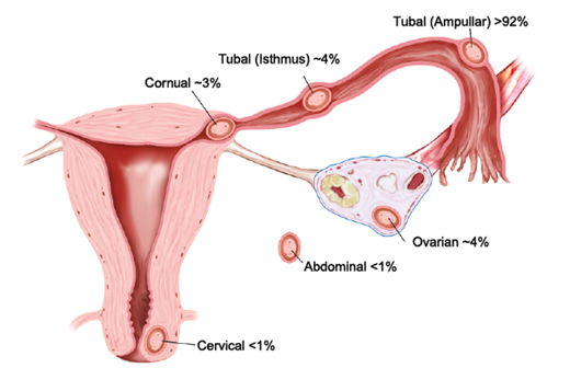 IVF рискове: 5.Ектопична бременност